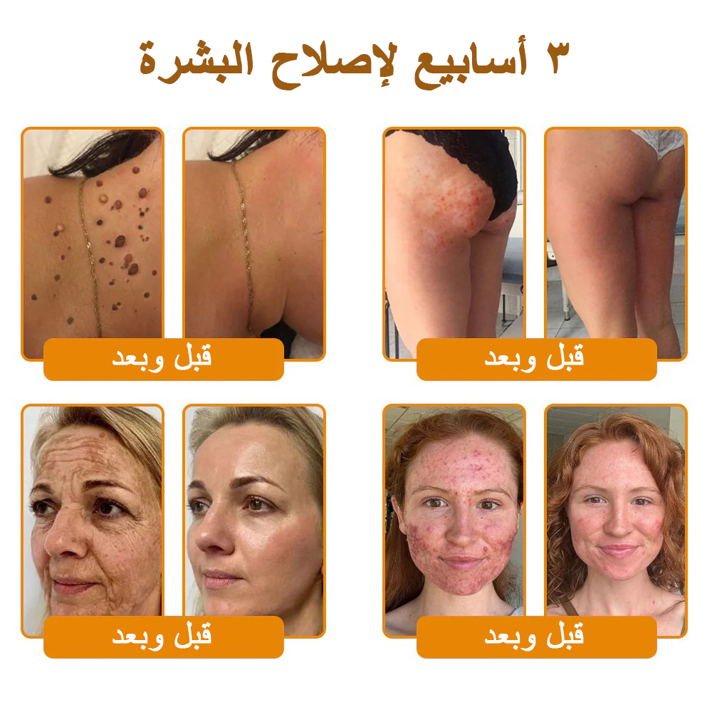 كريم VLSVLS® سم النحل لتجديد البشرة💥 (👩‍⚕️ مناسب لجميع الأعمار، موصى به من AAD) – مضاد للشيخوخة، يرطب، يعيد حيوية البشرة ويوحد لونها
